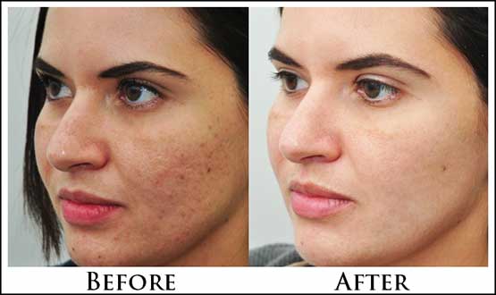 Diffuseur de Vapeur Facial – Hydratation et Purification Profonde de la Peau